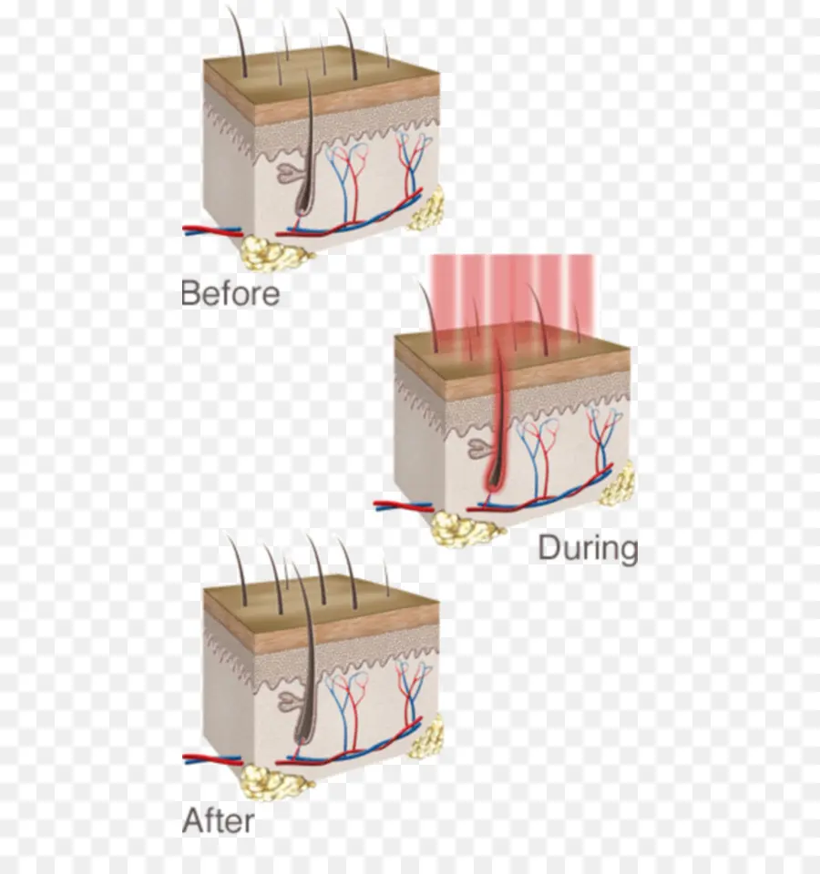Processo De Depilação，Pele PNG