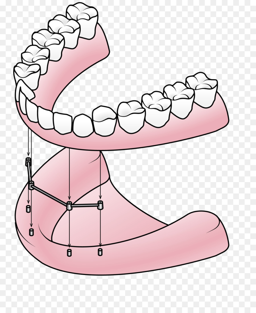 Aparelho Dentário，Dentes PNG