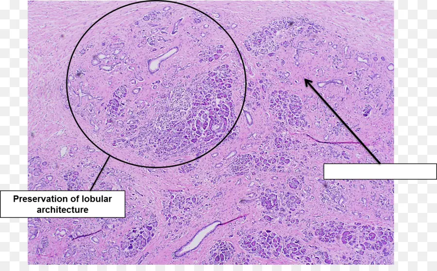 Pâncreas，Pancreatite Aguda PNG