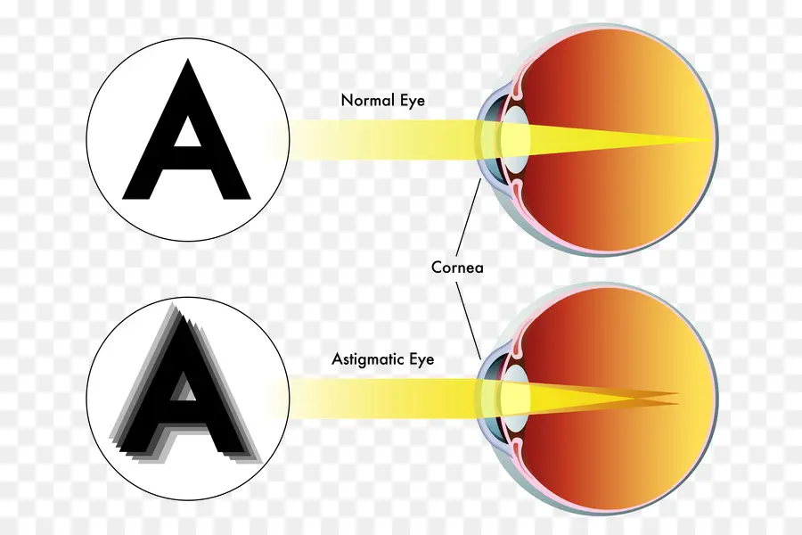 Olho Astigmático，Visão PNG