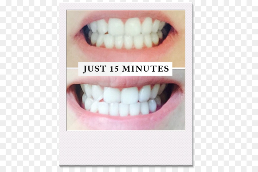 Branqueamento Dentário，De Dentes Humanos PNG