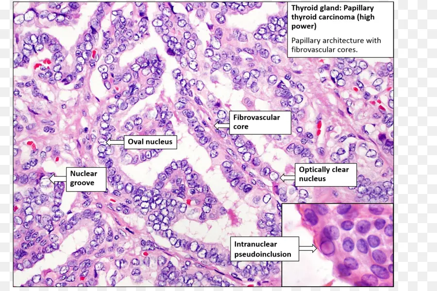 Glândula Tireóide，Carcinoma Papilífero De Tireoide PNG