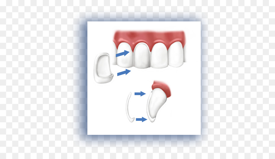 Verniz，Odontologia Estética PNG