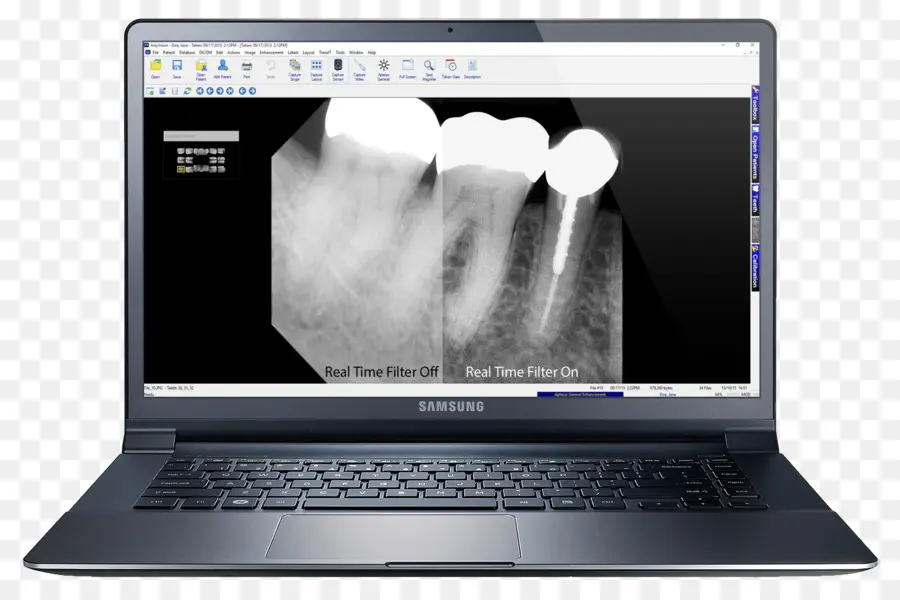 Radiografia Dentária，Dentes PNG