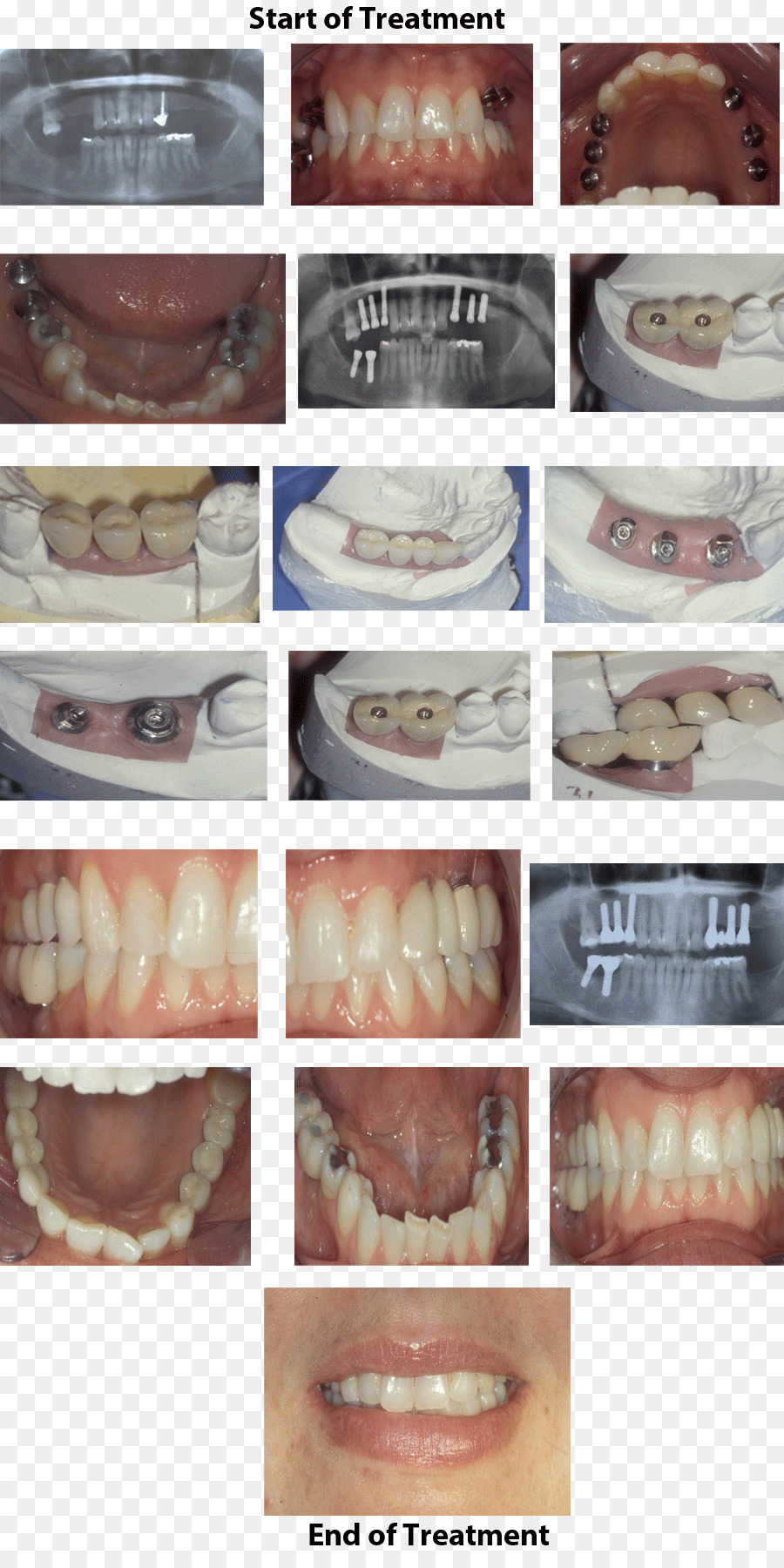 Kapshtica Renis Dds，Implante Dentário PNG