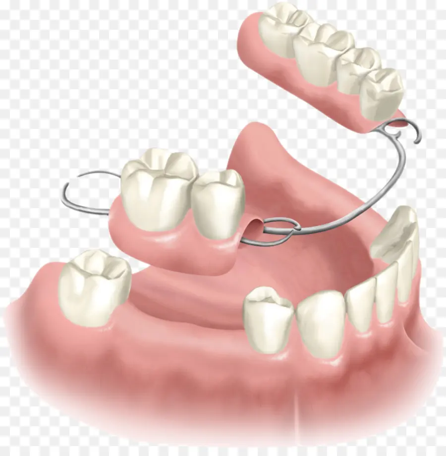 Prótese Parcial Removível，Dentaduras PNG