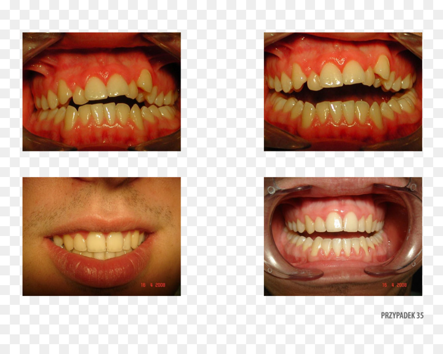 Dente，Gingivoplasty PNG