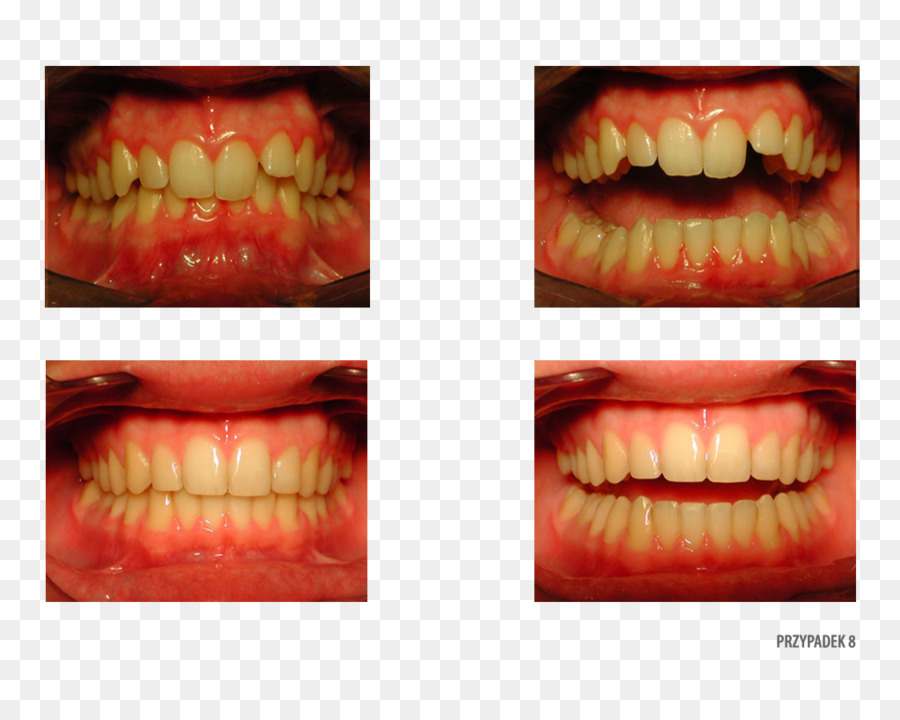 Dentes，Antes PNG