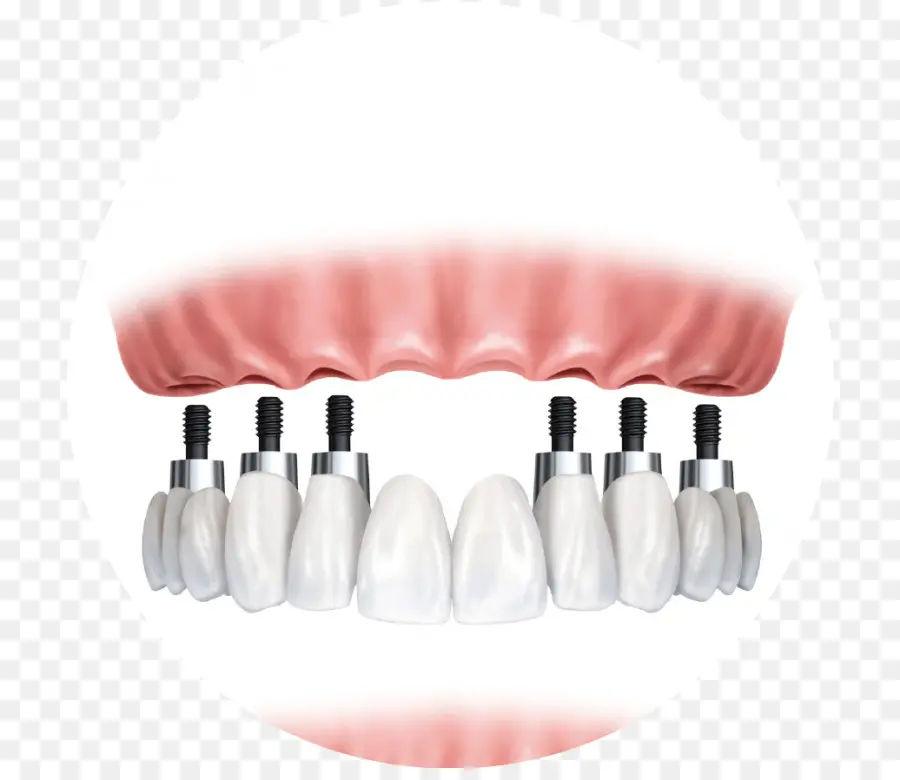 Implantes Dentários，Dentes PNG