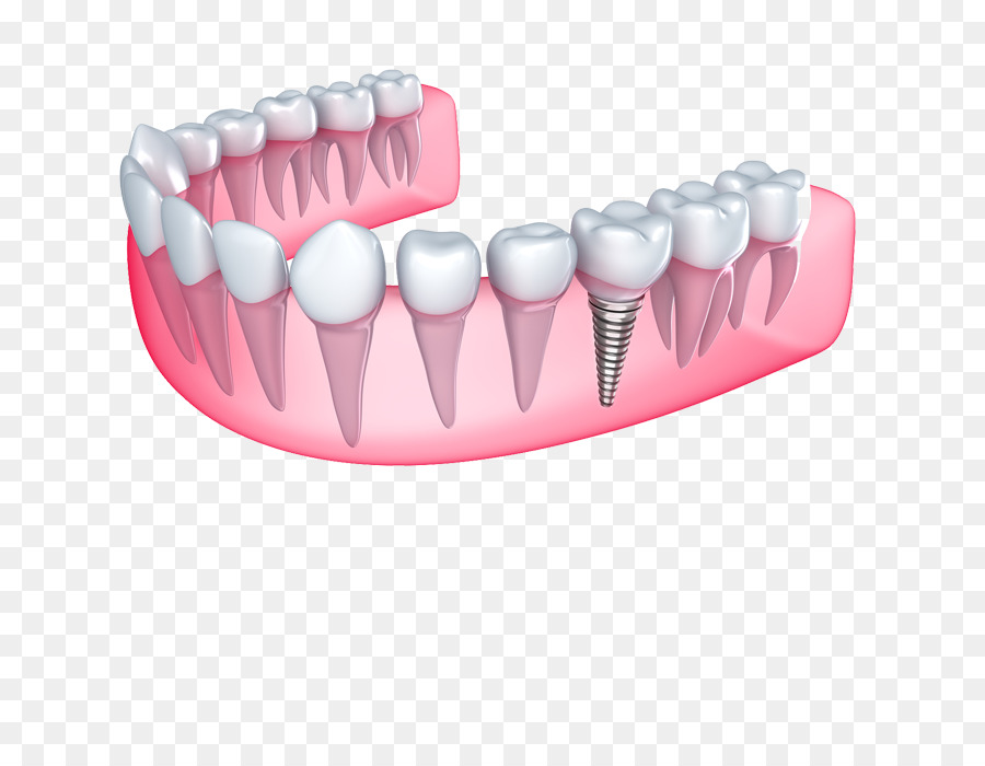 Implante Dentário，Dentes PNG