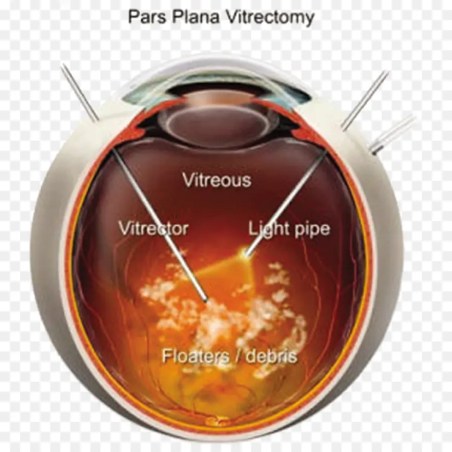 Cirurgia Ocular，Vitrectomia PNG