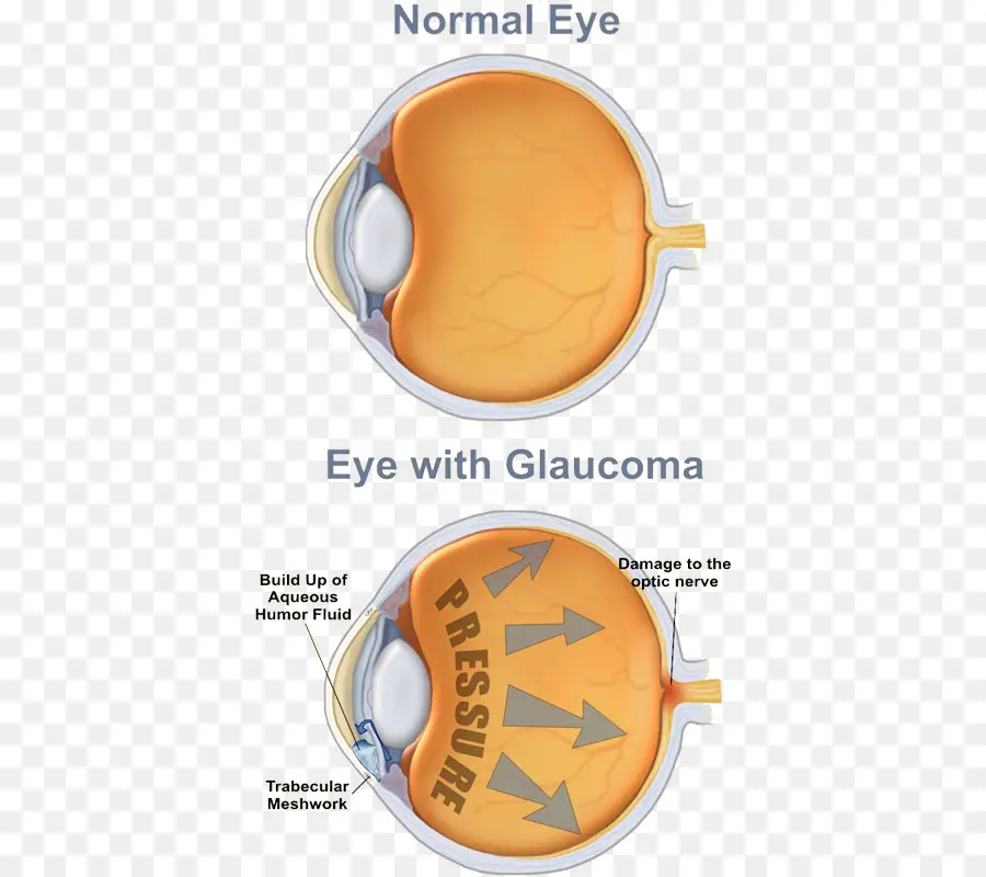 Glaucoma，Olho PNG