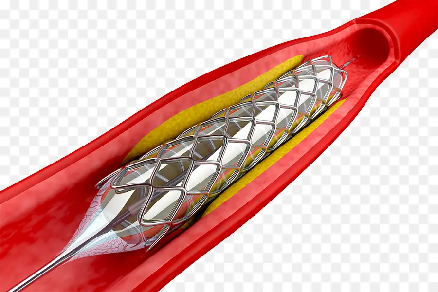 Angioplastia，A Intervenção Coronária Percutânea PNG