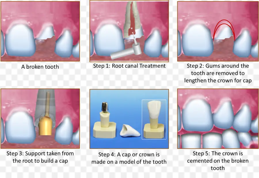 Procedimento De Coroa Dentária，Dental PNG