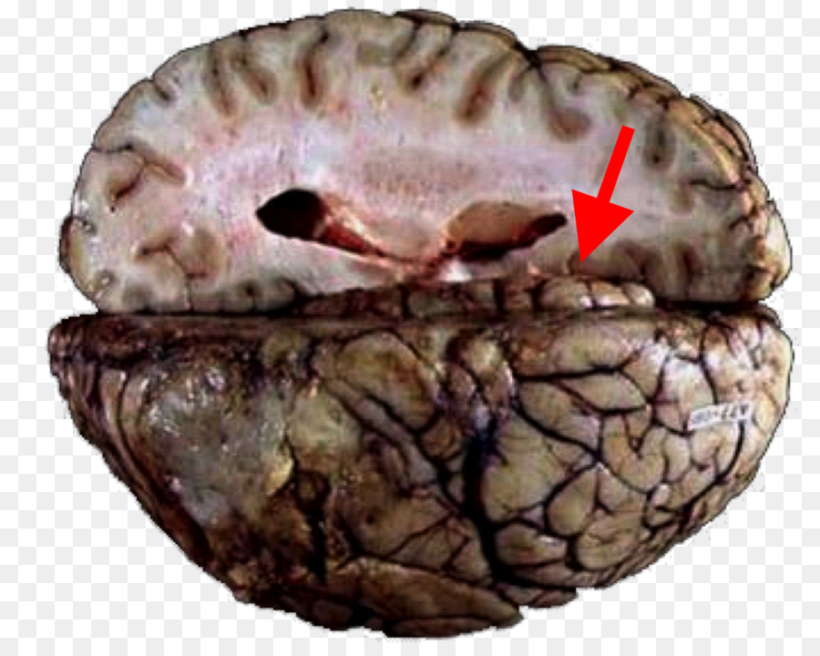 Cérebro Herniação，Cerebelar Tentorium PNG