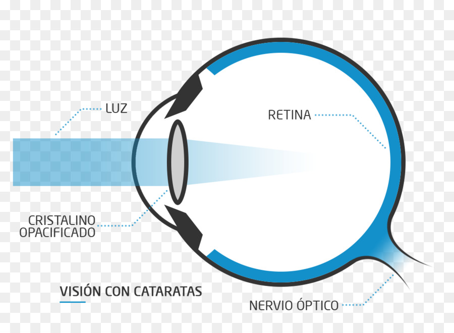 Diagrama De Miopia，Olho PNG