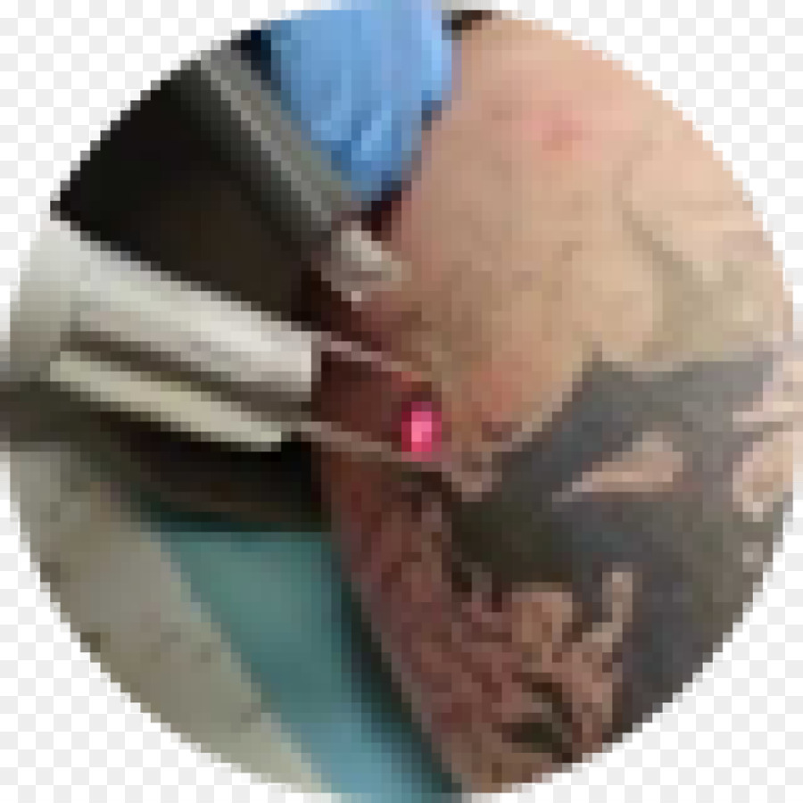 Remoção De Tatuagem，Tatuagem PNG