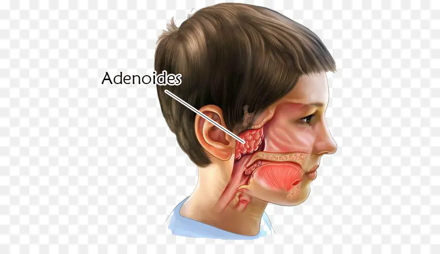 Diagrama De Adenóides，Criança PNG