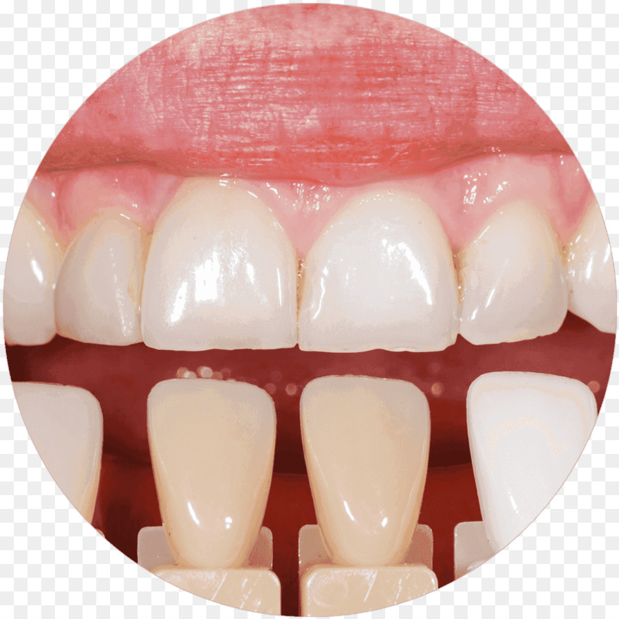 Branqueamento Dentário，Odontologia PNG