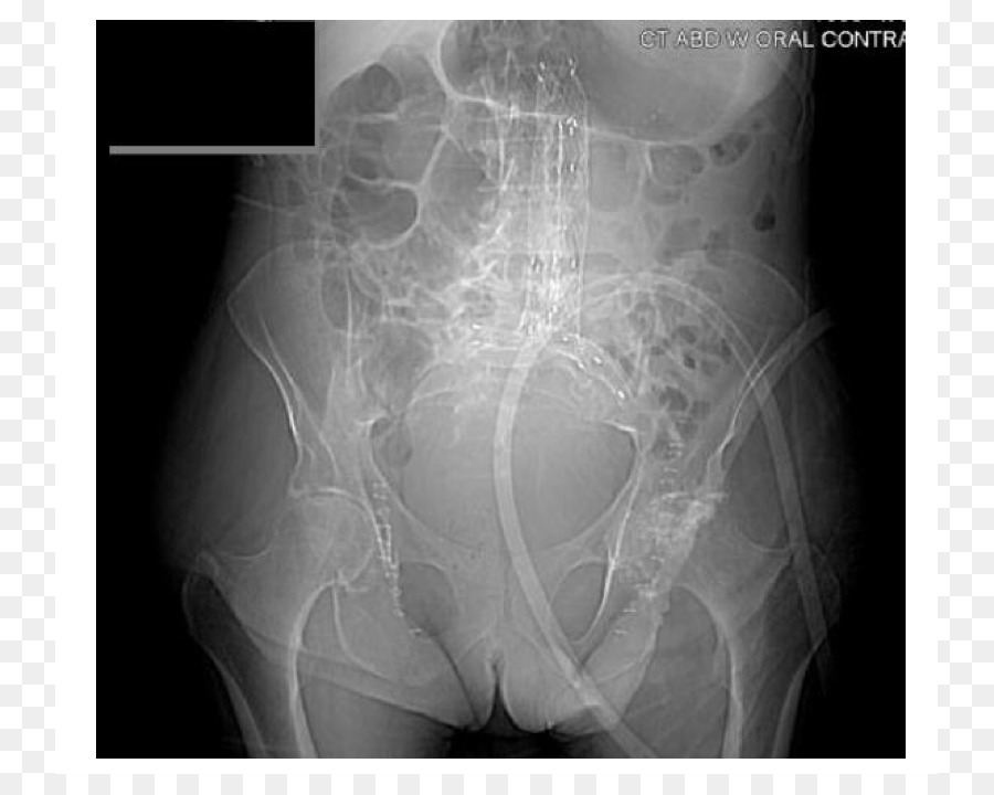 Aneurisma De Aorta Abdominal，Endovascular De Aneurisma De Reparação PNG