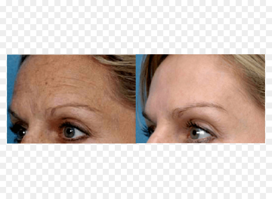 Fotorejuvenescimento，Rejuvenescimento Facial PNG