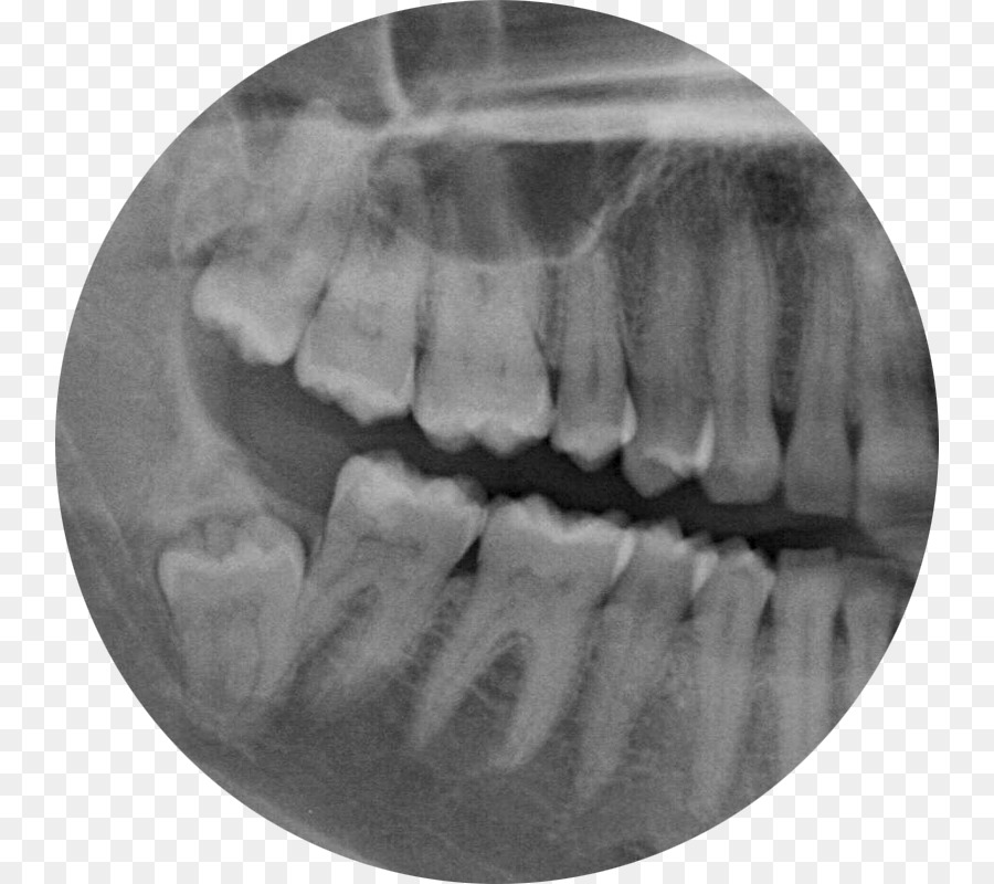 Radiografia Dentária，Dentes PNG