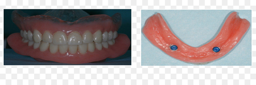 Dente，Dentaduras PNG