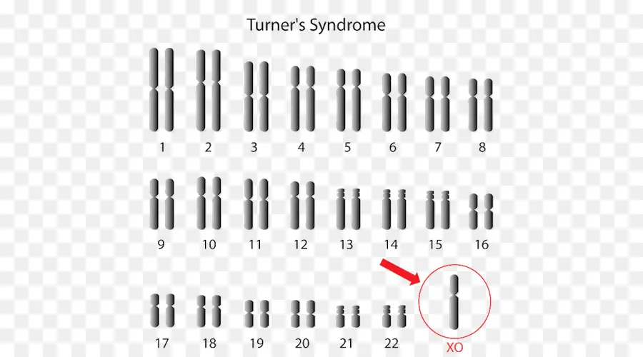 Monossomias，A Síndrome De Turner PNG