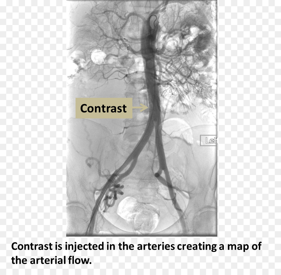 A Angiografia，Artéria Femoral PNG