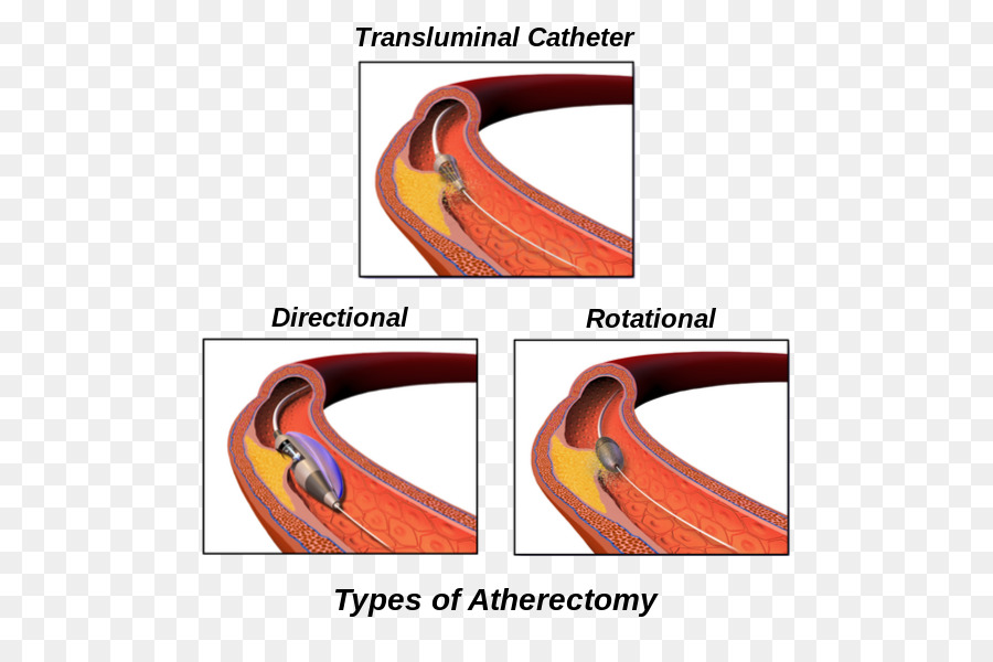 Aterectomia，Doença Arterial Periférica PNG