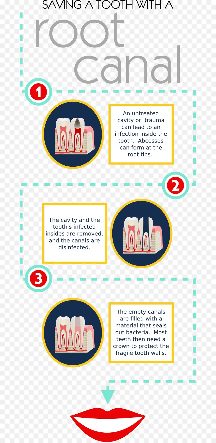 Procedimento De Canal Radicular，Dente PNG