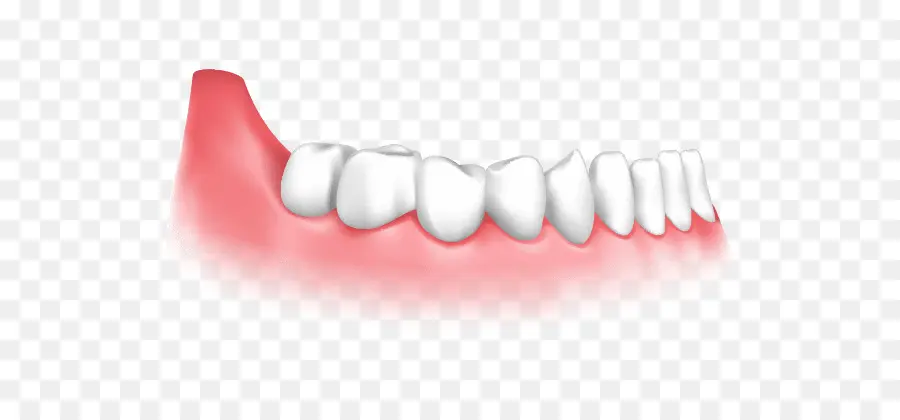 Implante Dentário，Odontologia PNG
