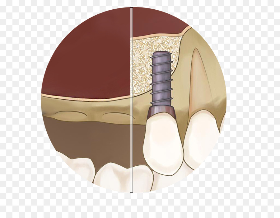 Implante Dentário，Dente PNG