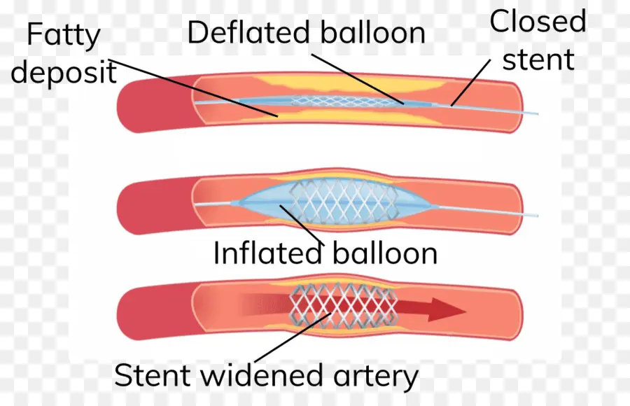 Procedimento De Stent，Artéria PNG