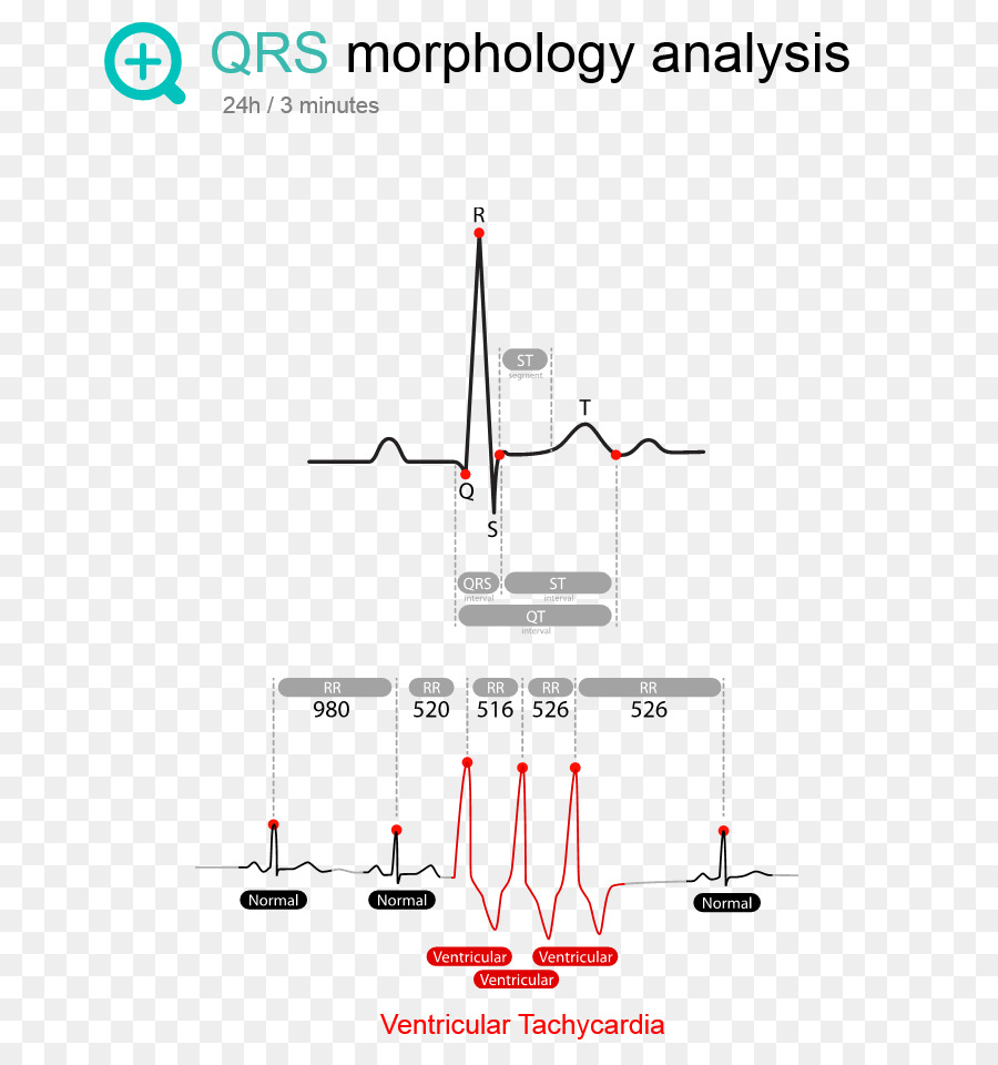 Análise Morfológica Do Qrs，Ecg PNG