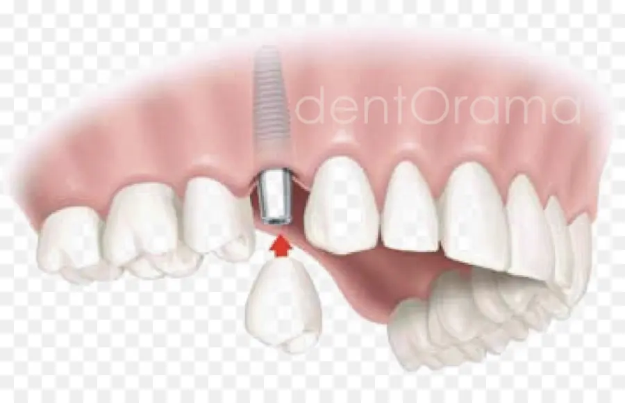 Implante Dentário，Dentista PNG