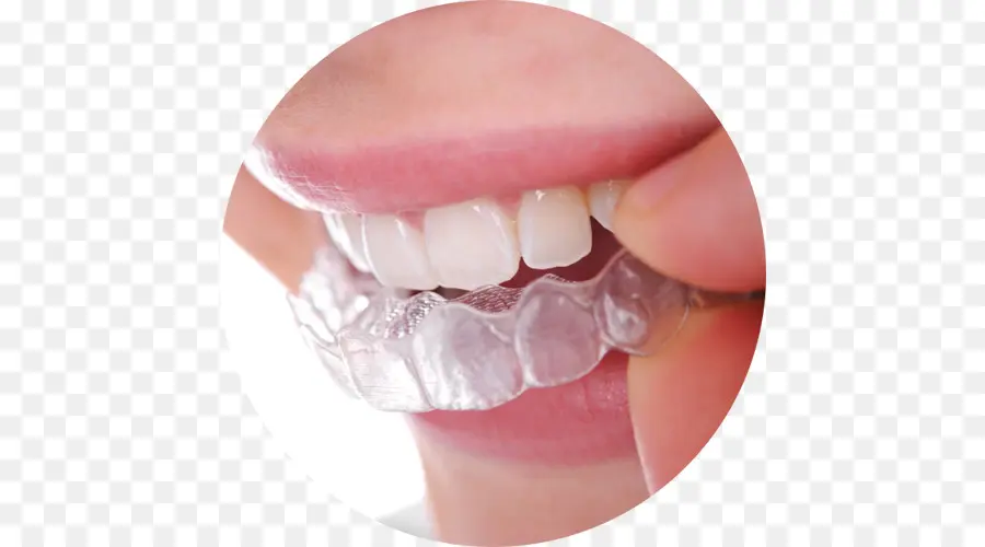 Alinhadores Claros，Aparelho Dental PNG