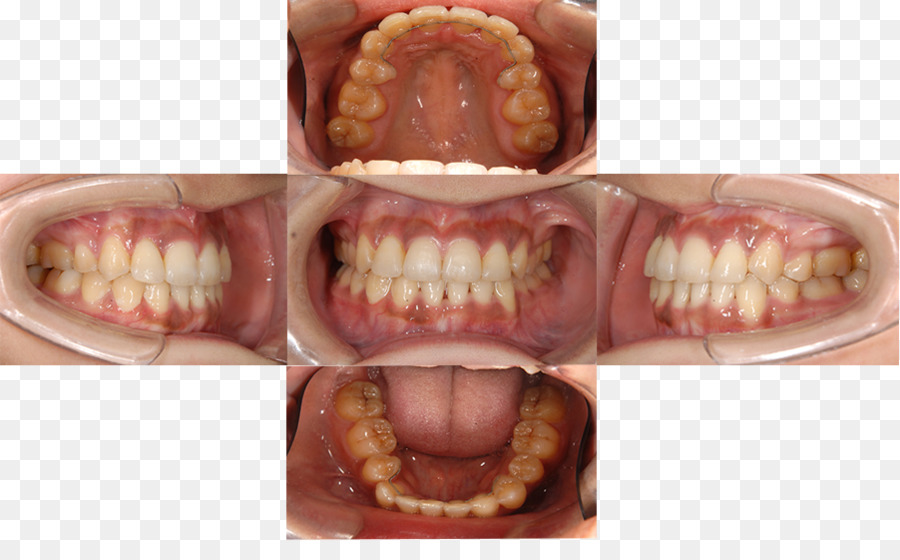 Dente，Doença Periodontal PNG