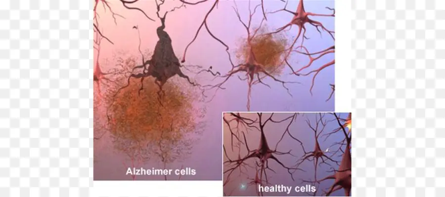 A Doença De Alzheimer，Associação De Alzheimer PNG