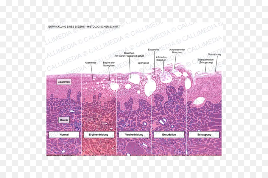 Desenvolvimento De Eczema，Pele PNG