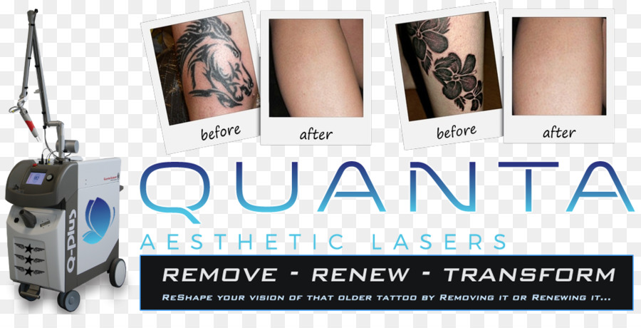 Ponto De Inflamação Empresa De Tatuagem，Remoção De Tatuagem PNG