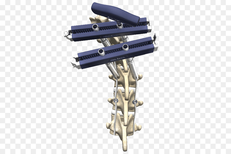 Coluna Vertebral，Cirurgia PNG