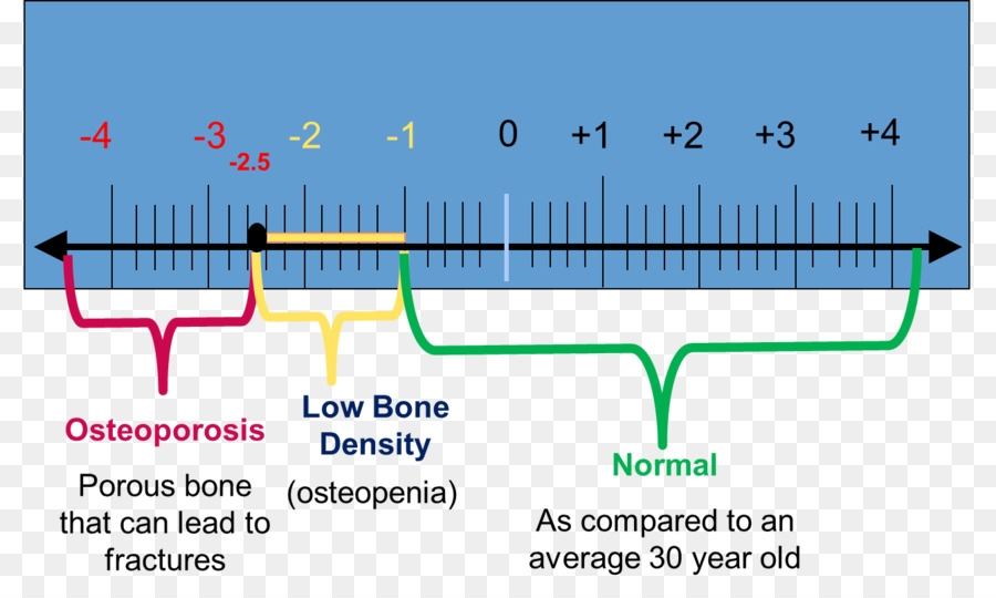 Gráfico De Densidade óssea，Osteoporose PNG