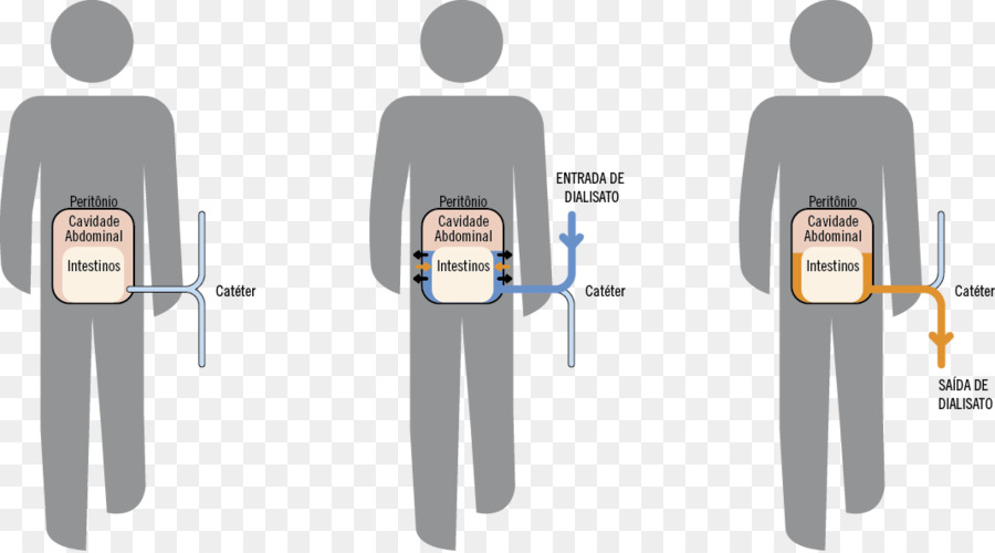 Diálise Peritoneal，Casa De Banho PNG