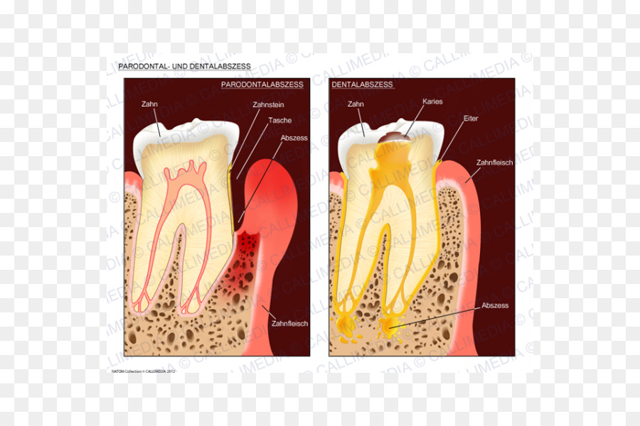 Abcesso Dental，Abscesso PNG