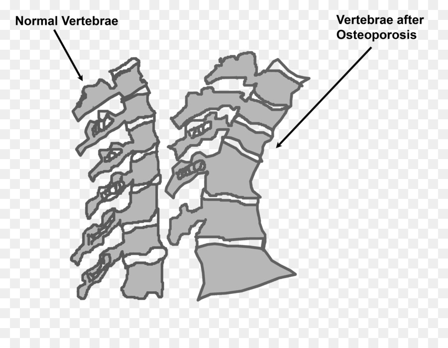 A Osteoporose，Coluna Vertebral PNG