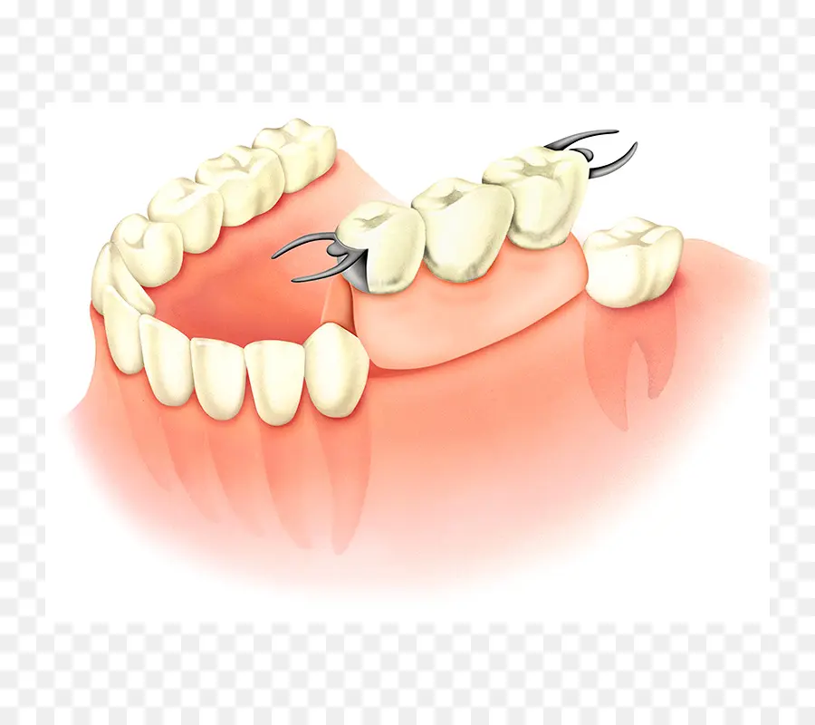 Prótese Dentária，Dentes PNG