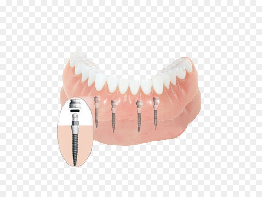 Dente，Dentaduras PNG