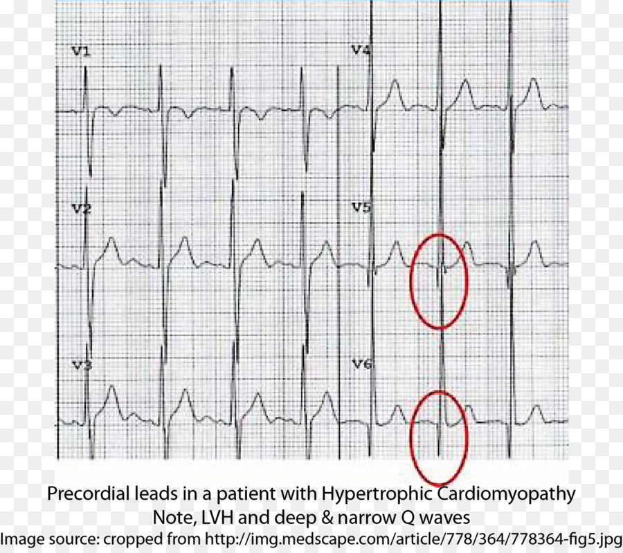 Gráfico De Ecg，Coração PNG