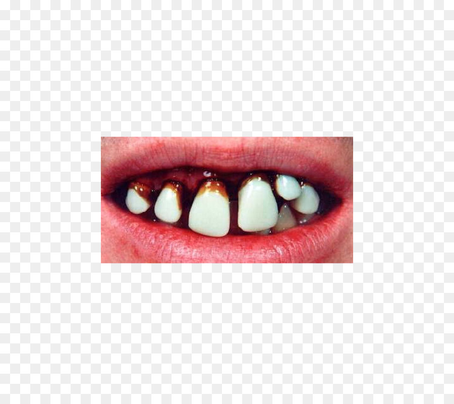 Dentes Com Cárie，Dentes PNG